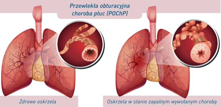 Przewlekły stan zapalny – wróg, którego trzeba eliminować