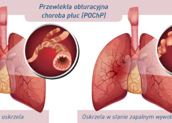 Przewlekły stan zapalny – wróg, którego trzeba eliminować